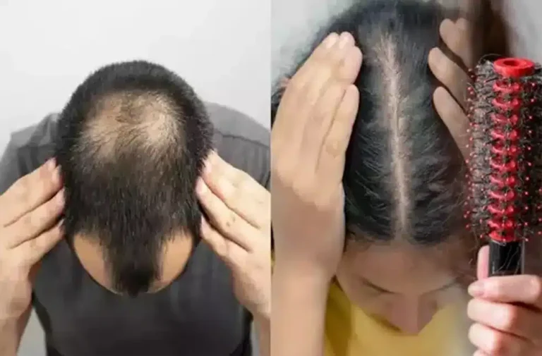 घर में मौजूद सरसों का तेल ही खत्म कर देगा गंजापन, बांस की तरह बढ़ेंगे बाल, तरीका यह अपनाएं sarso tel ke fayde in hindi