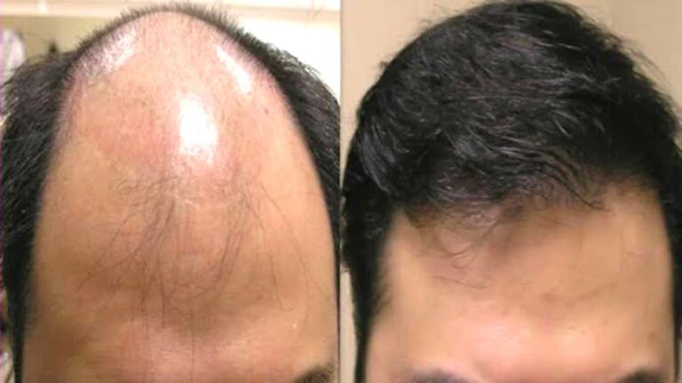 nae ghane bal kaise ugaen