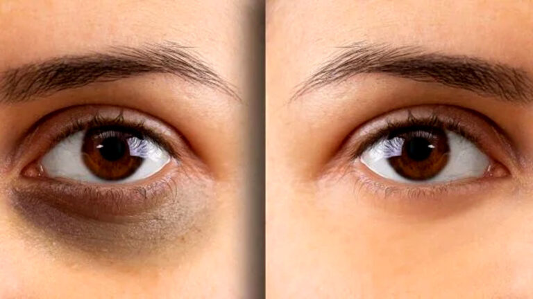 dark circles