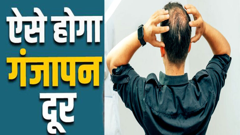 गंजे सिर में बाल उगा सकती हैं ये 3 चीजें! आज से ही शुरू करें खाना ganjapan kaise door karen